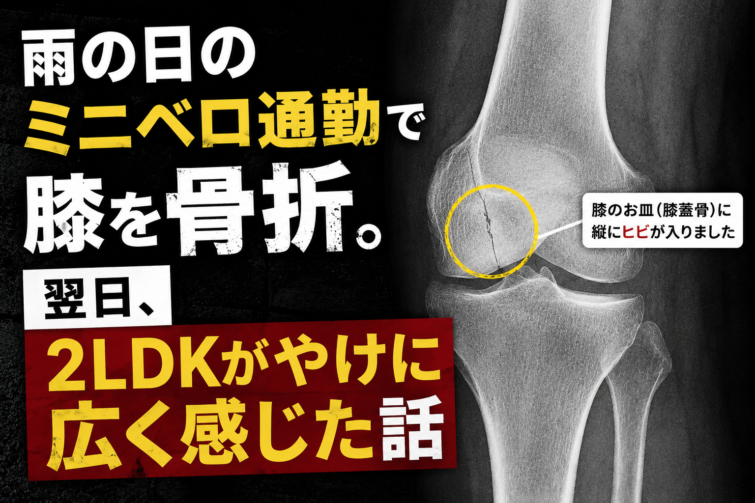 雨の日のミニベロ通勤で転倒し膝のお皿を骨折。レントゲン写真と翌日に感じた5つの気づきを紹介する記事